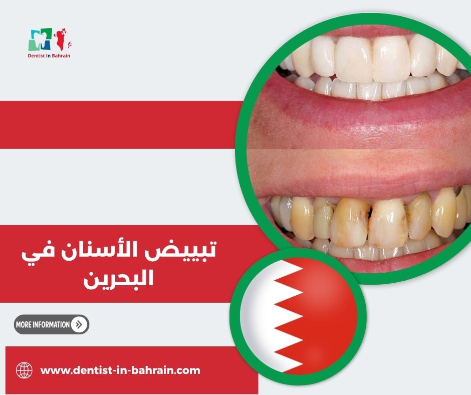 تبييض الأسنان بالليزر في مدينة حمد: تقنية حديثة لابتسامة مشرقة