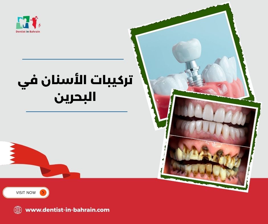 العناية بتركيبات الأسنان في الرفاع: نصائح للحفاظ عليها