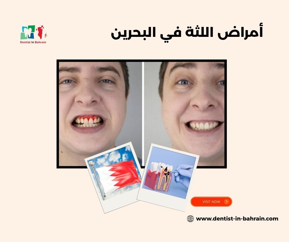 الوقاية من أمراض اللثة في المحرق: نصائح للحفاظ على صحة الفم الوقاية من أمراض اللثة في المحرق: نصائح للحفاظ على صحة الفم