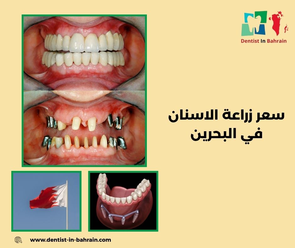 سعر زراعة الاسنان في البحرين