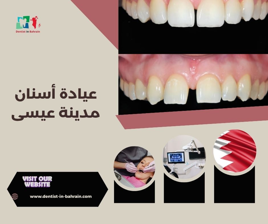 عيادة أسنان مدينة عيسى لعلاج العصب والحشوات