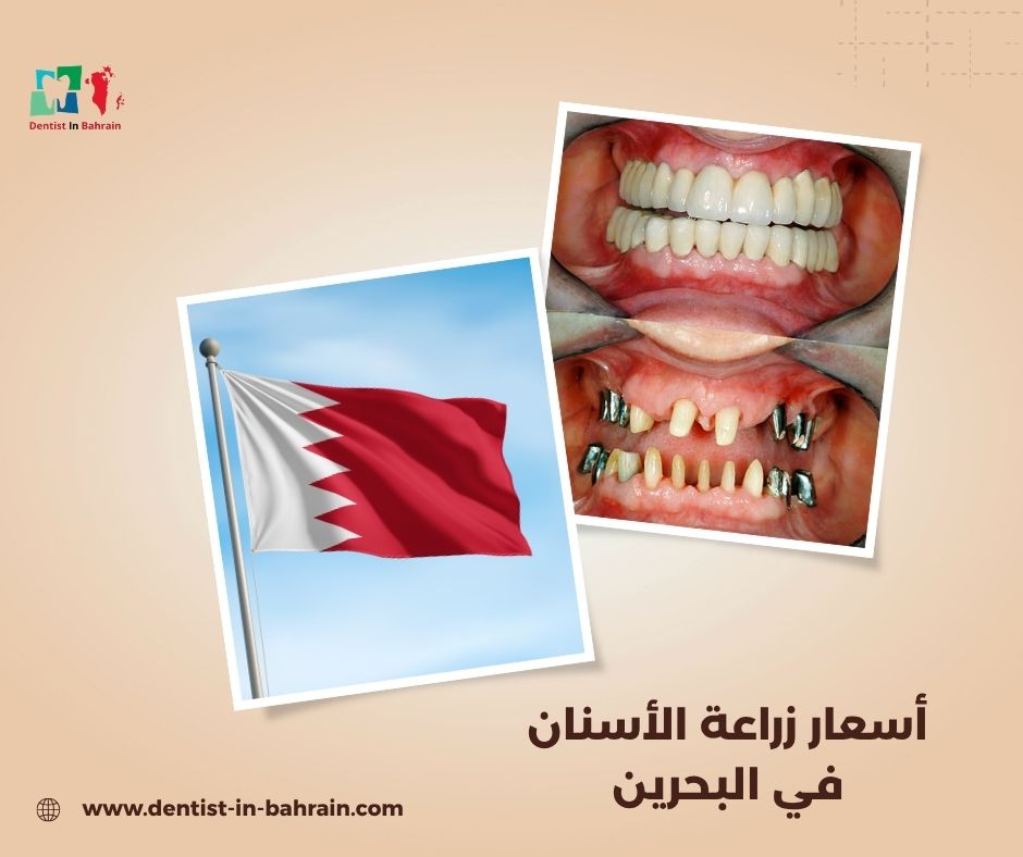 أسعار زراعة الأسنان في البحرين 