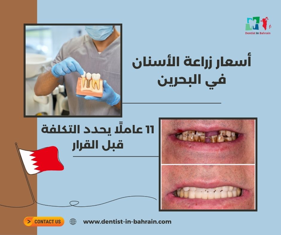 أسعار زراعة الأسنان في البحرين