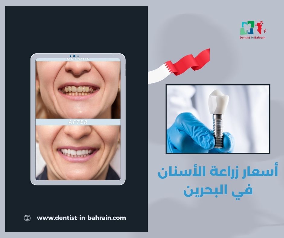 أسعار زراعة الأسنان في البحرين 