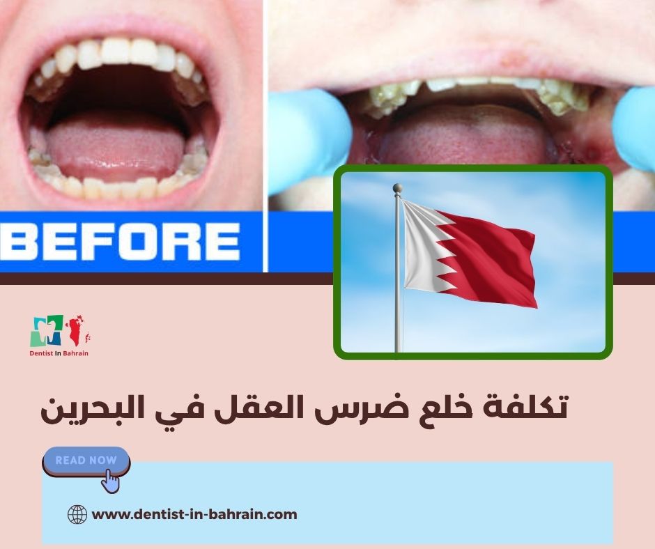 تكلفة خلع ضرس العقل في البحرين حسب المناطق